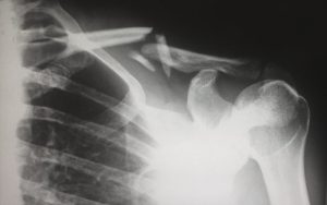 xray of injured shoulder